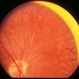 Retinitis Pigmentosa with peripheral arteriolar narrowing